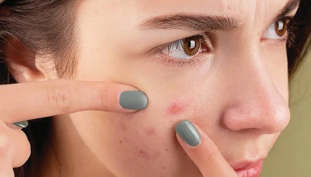 Acne Treatment