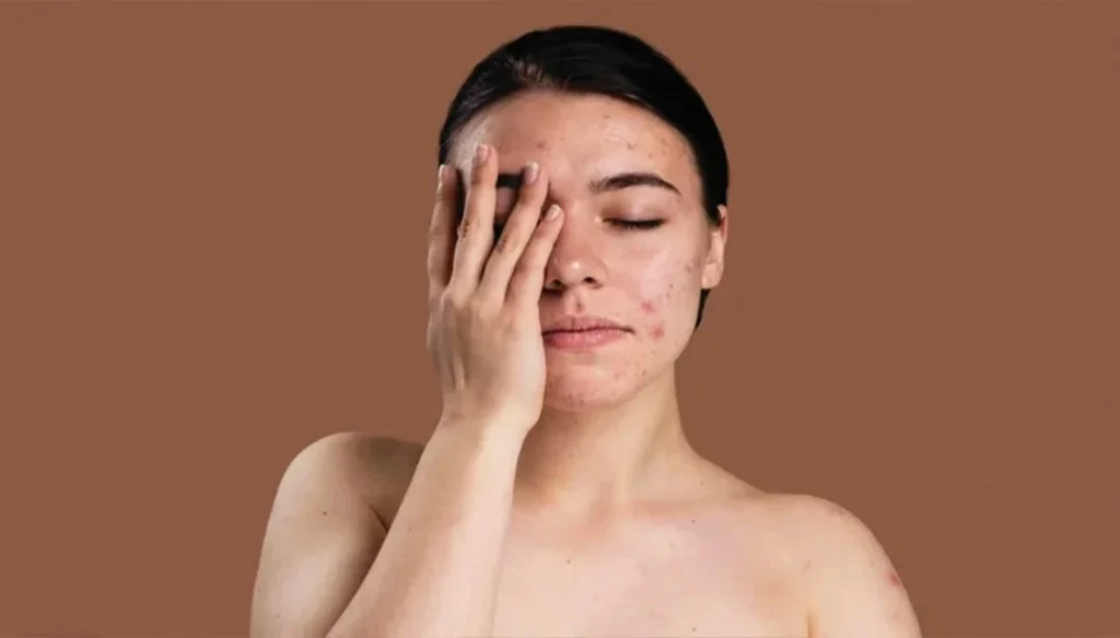 أفضل دكتورة جلدية لعلاج حب الشباب في دبي