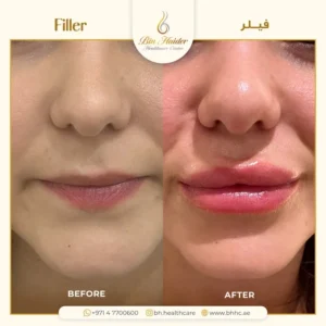 أسعار الفيلر في دبي للشفايف والوجه  
