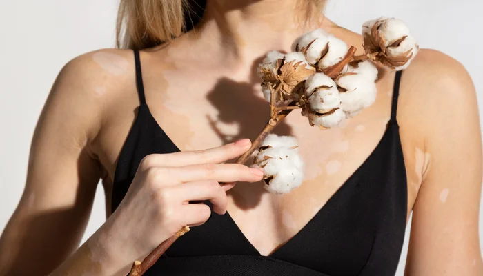 هل يوجد علاج للبهاق؟ علاج البهاق نهائيا في ساعة 1 علاج البهاق في الإمارات