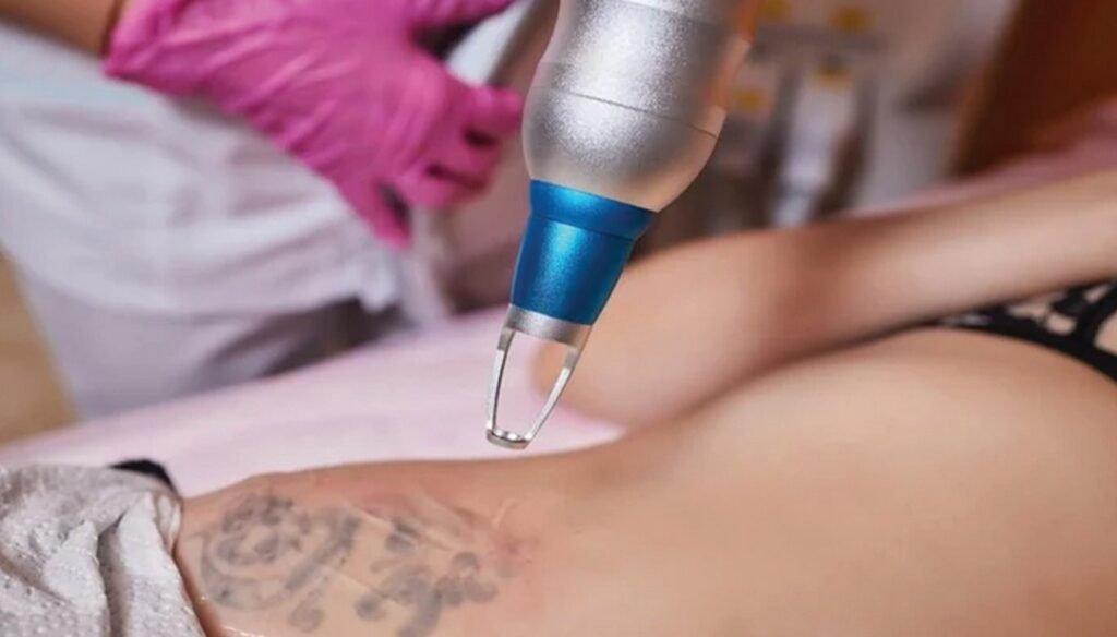 إزالة الوشم بالليزر