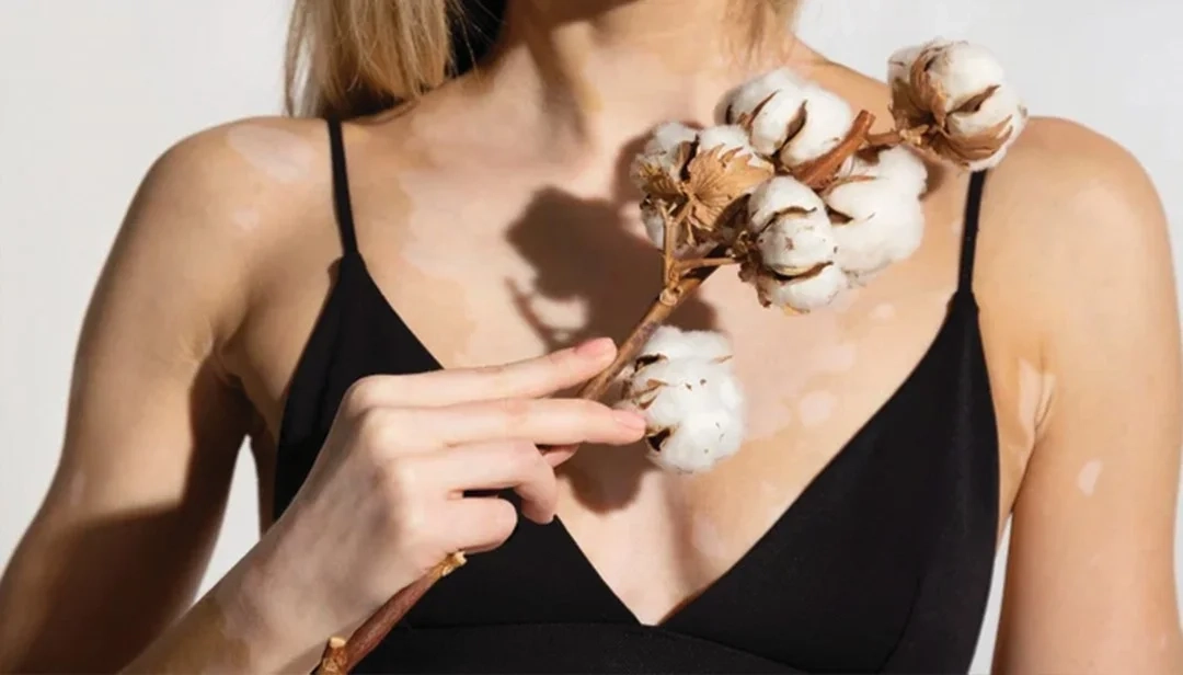 هل يوجد علاج للبهاق؟ علاج البهاق نهائيا في ساعة