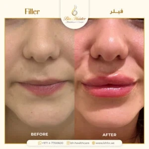 أفضل عيادة فيلر في دبي