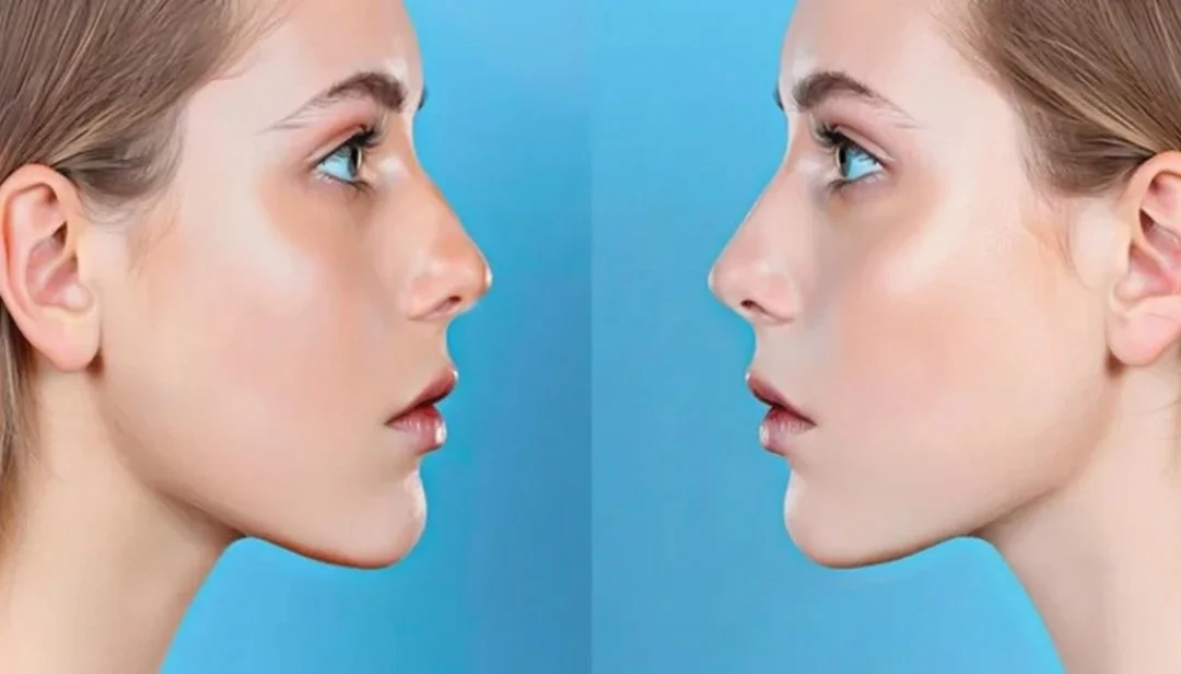 مقالات 219 سعر جراحة تجميل الأنف في دبي بالإمارات | عملية ترميم الأنف | د. حصة بن حيدر