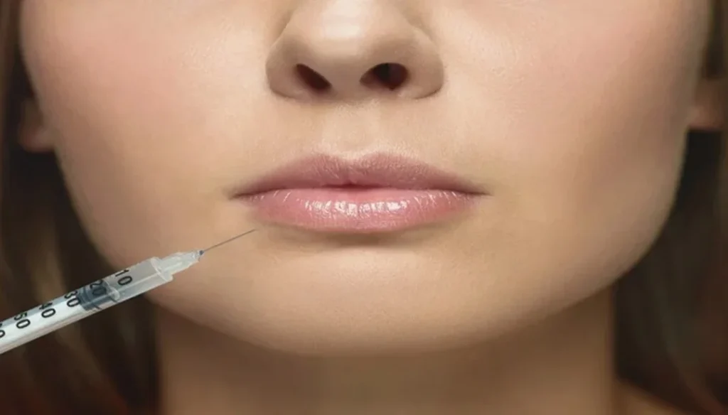 الشفايف الروسية قبل وبعد | د. حصة بن حيدر افضل طبيب تجميل في دبي