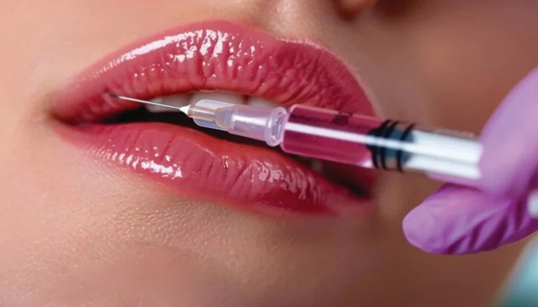 متى يزول تورم الشفايف بعد الفيلر | د. حصة بن حيدر