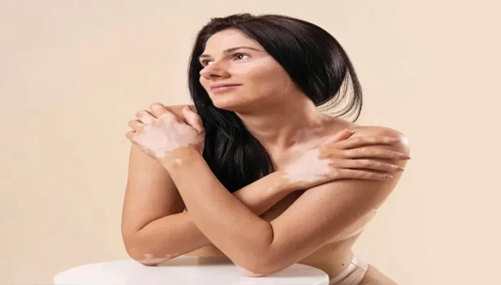 هل يوجد علاج للبهاق؟ علاج البهاق نهائيا في ساعة