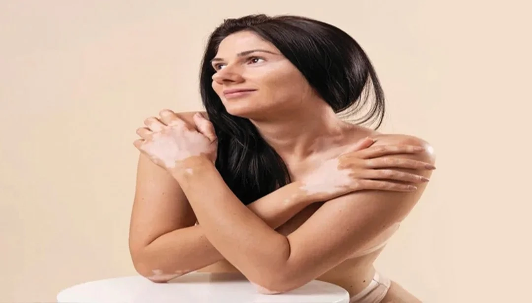 هل يوجد علاج للبهاق؟ علاج البهاق نهائيا في ساعة