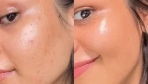 استخدامات الميزوثيرابي للوجه في دبي والشارقة لبشرة أكثر جاذبية