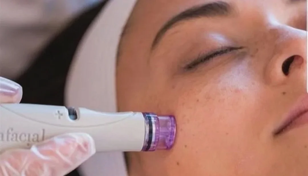 مقالات 143 علاج الوخز بالإبر الدقيقة في دبي والشارقة لبشرة أكثر إشراقا