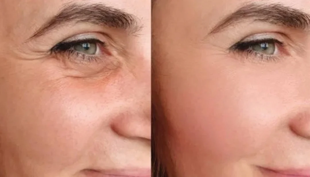 مقالات 163 استخدامات البوتوكس التجميلية والعلاجية لمظهر شبابي