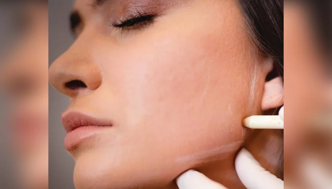 أماكن حقن الفيلر في الوجه لمظهر متناسق وشبابي