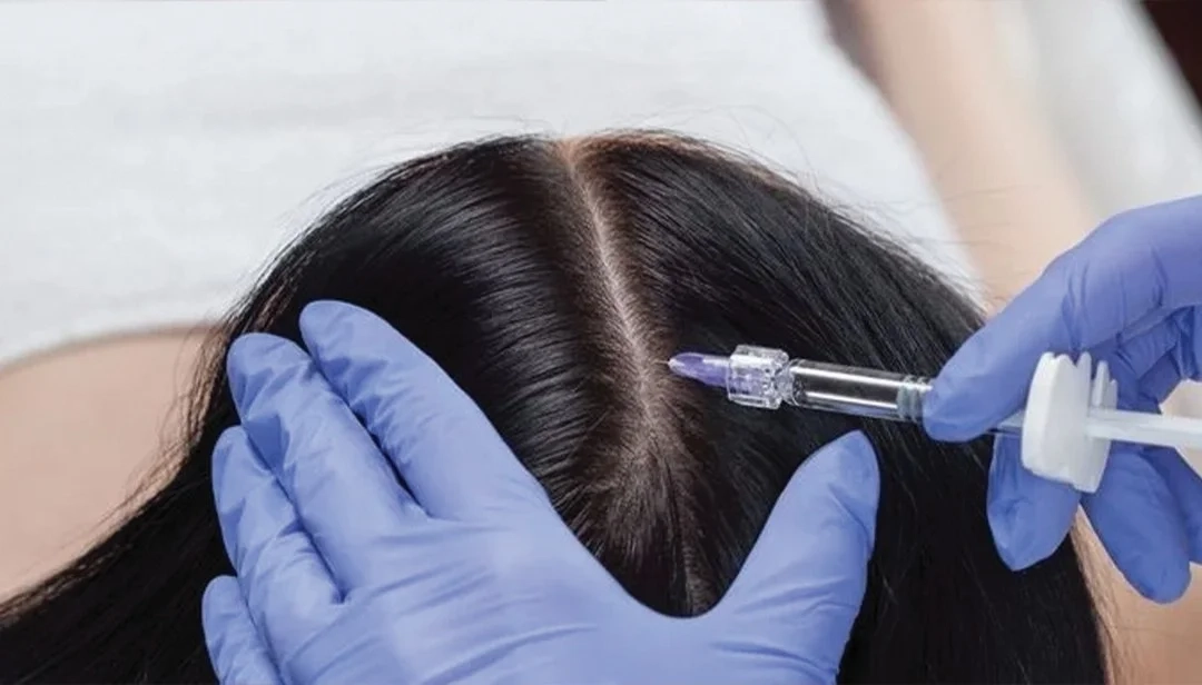 علاج الميزوثيرابي للشعر أفضل تقنية لمشكلة التساقط