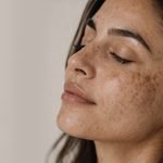 What Is Melasma and Why Is It So Common in the Gulf?
